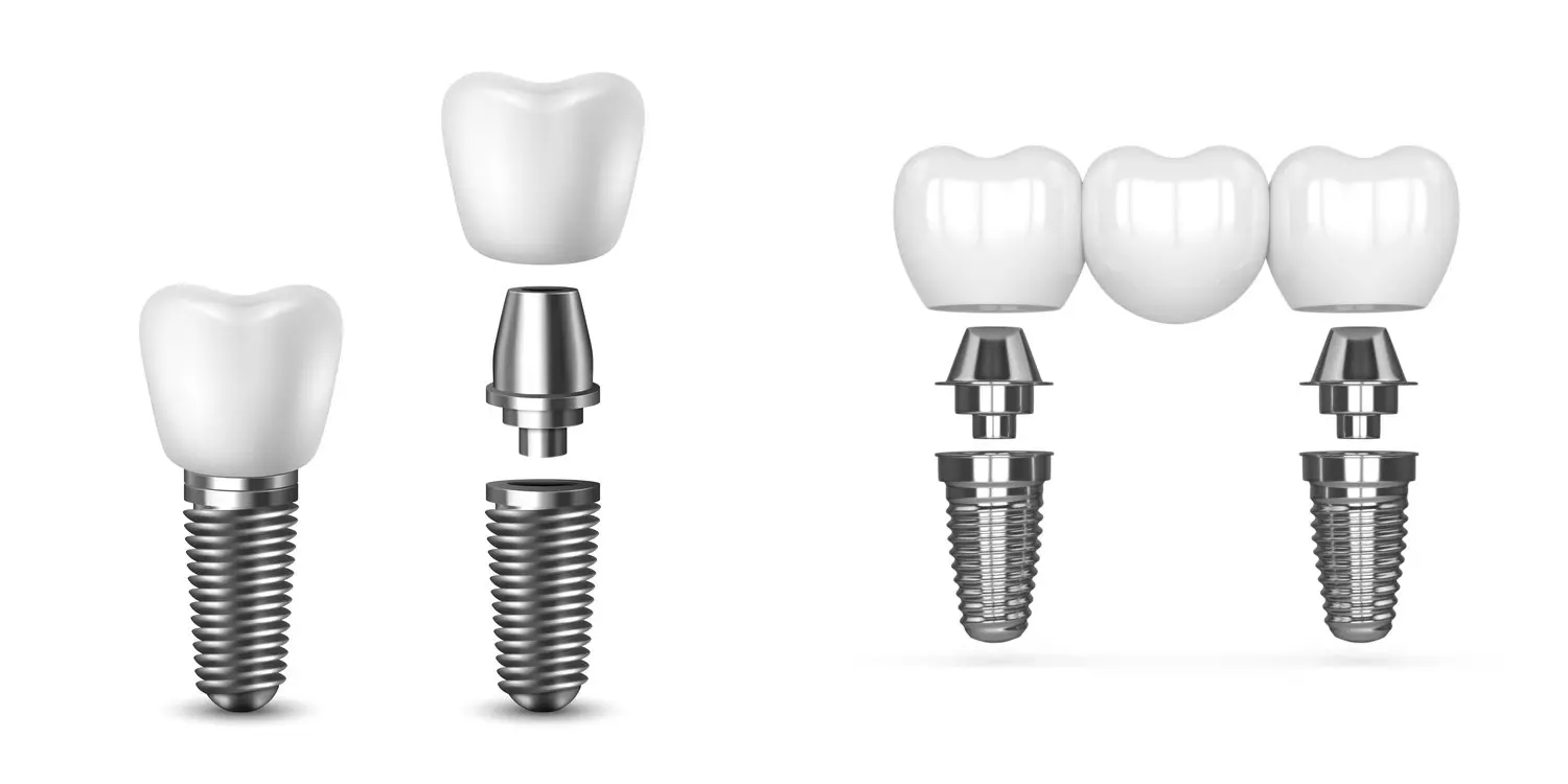 model of single dental implant and multi-tooth implant bridge