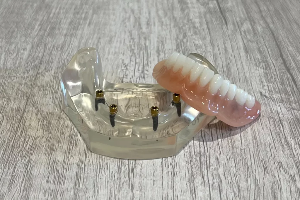 snap-in implant dentures at Villanova Dental Group