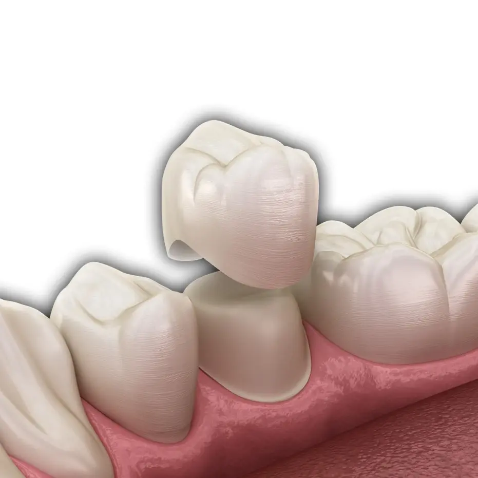 graphic of a porcelain dental crown