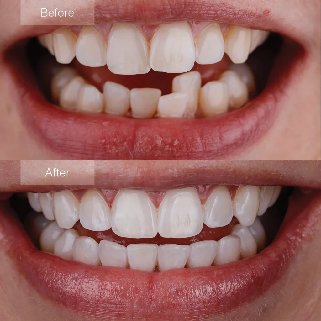 clear aligner treatment before and after