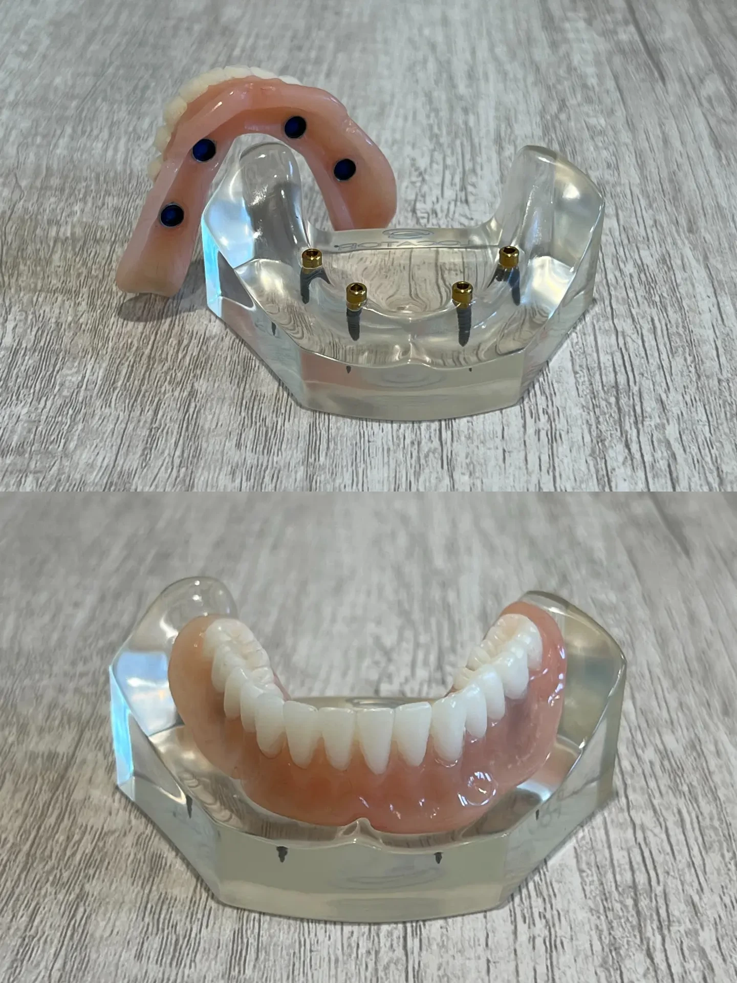 bottom snap in implant denture unsnapped and snapped
