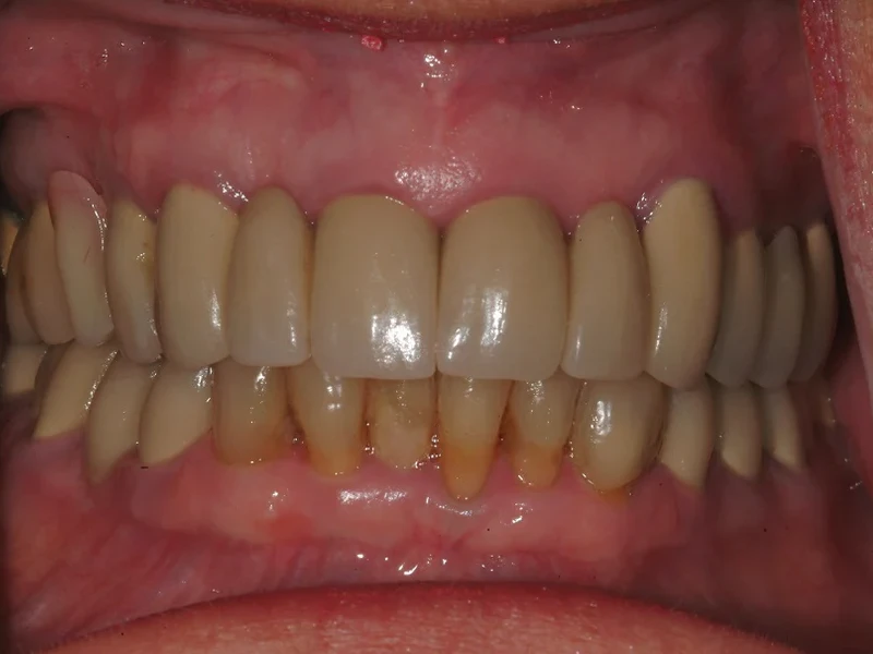 1-Before advanced reconstructive dentistry with dental implants