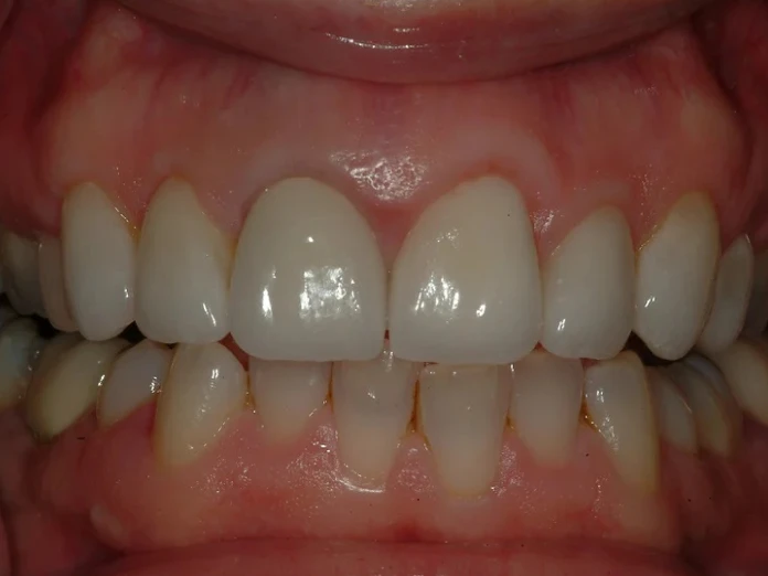 4-After laser gum lift surgery, custom crowns, and veneers