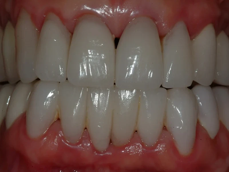 5-After major bite corrections, custom crowns, bridges, and veneers all teeth