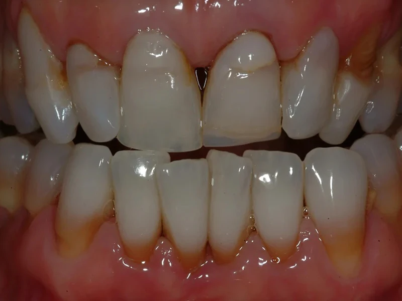 5-Before major bite corrections, custom crowns, bridges, and veneers all teeth