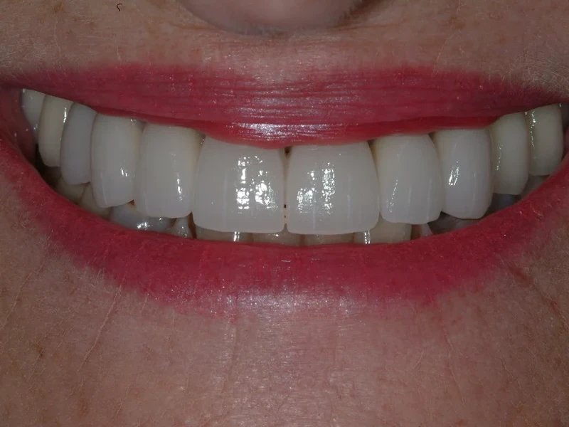 6-After dental implant and tooth supported front teeth