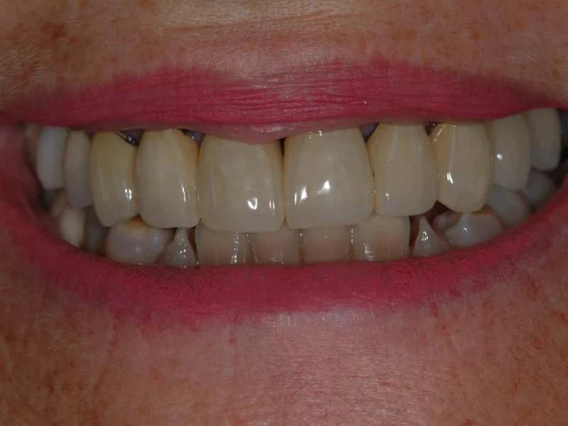 6-Before dental implant and tooth supported front teeth