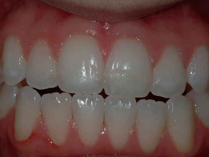 7-After white spot removal and bleaching_whitening