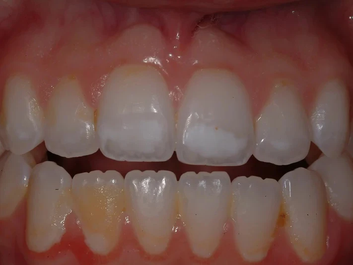 7-Before white spot removal and bleaching_whitening