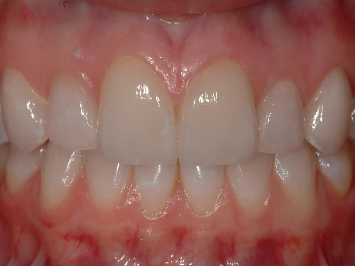 8-After custom porcelain ceramic veneers upper 6 front teeth