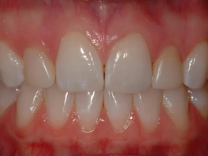 8-Before custom porcelain ceramic veneers upper 6 front teeth