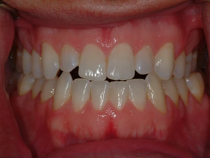 9-Before major bite correction and custom porcelain ceramic veneers upper 4 front teeth
